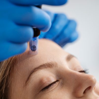 Dermapen en Alzira: rejuvenece tu piel con tecnología de microneedling avanzada